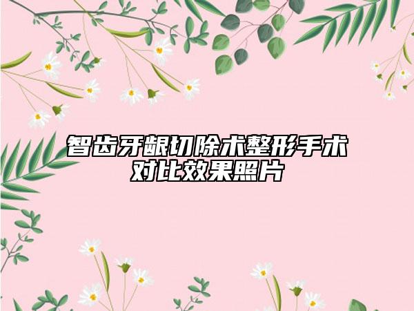 智齒牙齦切除術(shù)整形手術(shù)對(duì)比效果照片